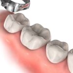 foto ligadura de separacion de molar en ortodoncia