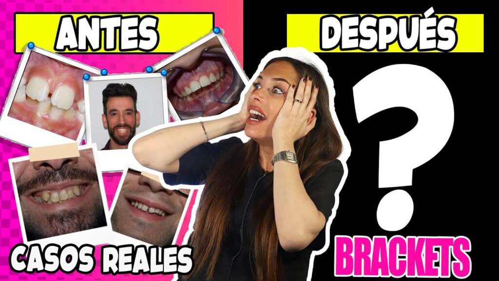 fotos del despues d ortodoncia dientes chicos