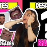 fotos del despues d ortodoncia dientes chicos