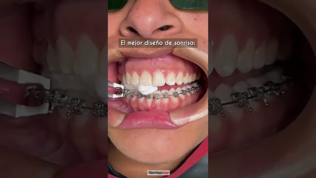 fotos ortodoncia esteticos