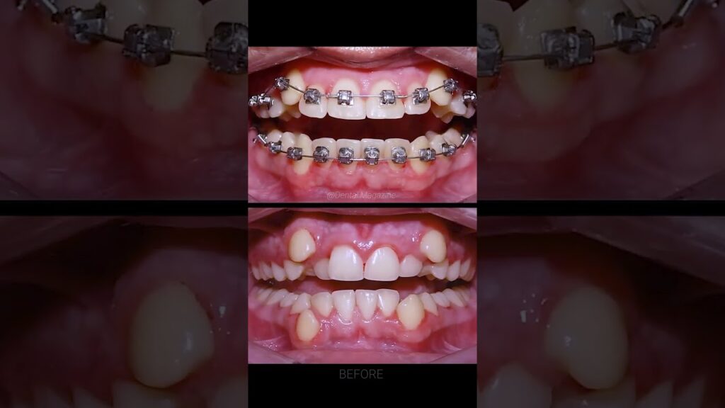 full smile system ortodoncia