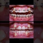 full smile system ortodoncia