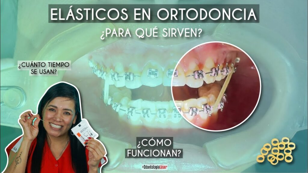 funcionamiento gomas ortodoncia