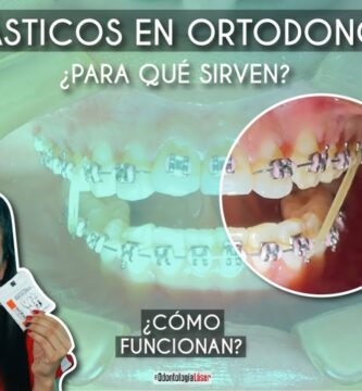 funcionamiento gomas ortodoncia