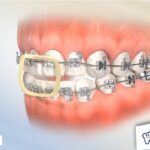 gomas de sepracion ortodoncia solo en dientes incisivos