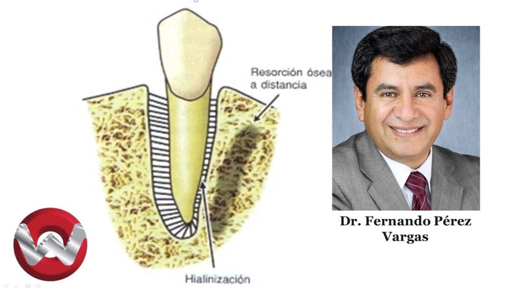 hialinizacion ortodoncia