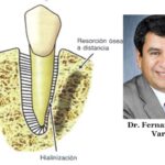 hialinizacion ortodoncia