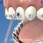 higiene dental con ortodoncia