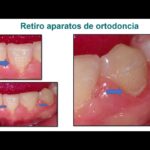 hiperplasia gingival por ortodoncia tratamiento