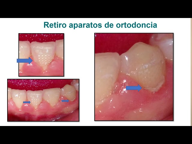 hiperplasia gingival por ortodoncia tratamiento