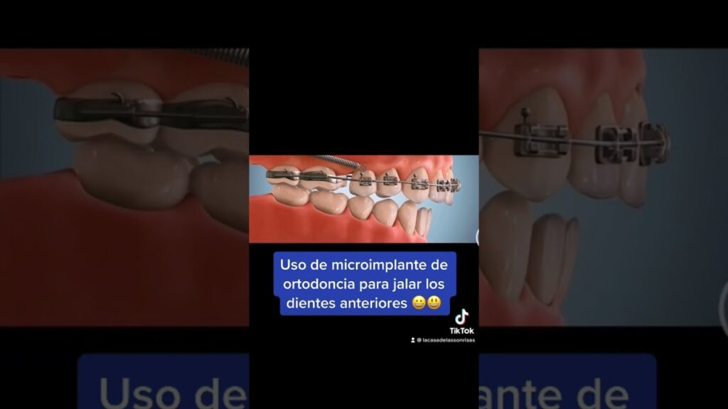 hoz anterior ortodoncia periodoncia