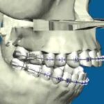 impactacion ortodoncia