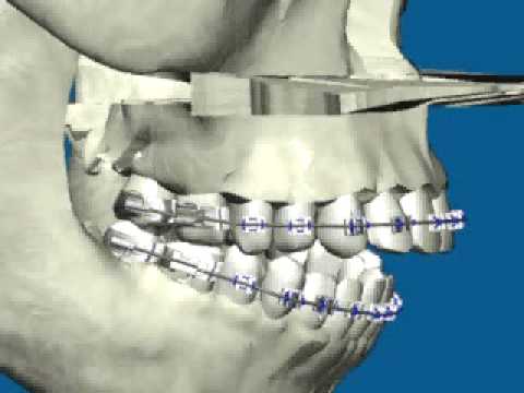 impactacion posterior ortodoncia