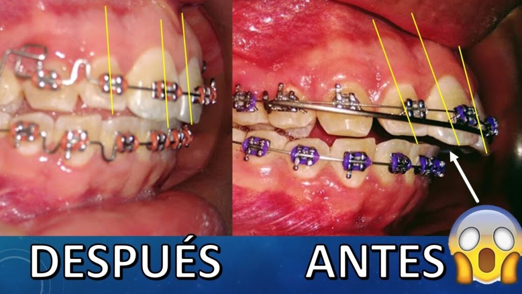 inclinacion vestibular ortodoncia