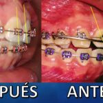 inclinacion vestibular ortodoncia