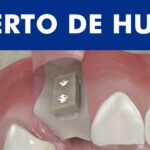 indicaciones injertos mucogingivales ortodoncia