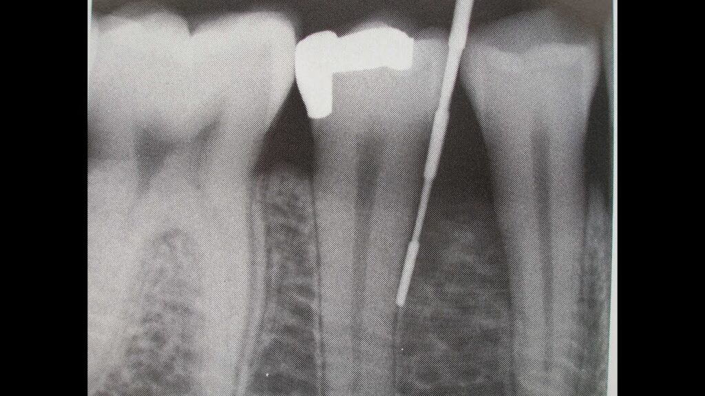 inflamacion ligamento periodontal rx ortodoncia