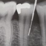 inflamacion ligamento periodontal rx ortodoncia