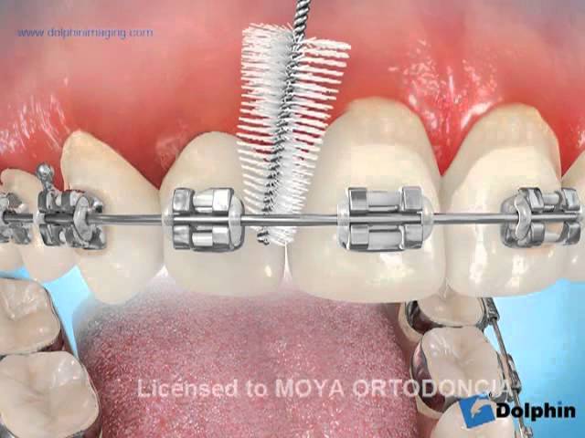 interprox ortodoncia