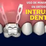 intrusion individual con microtornillo ortodoncia