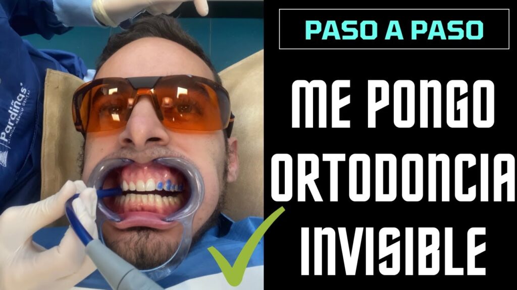 invasiling para no interrumpir ortodoncia en boda