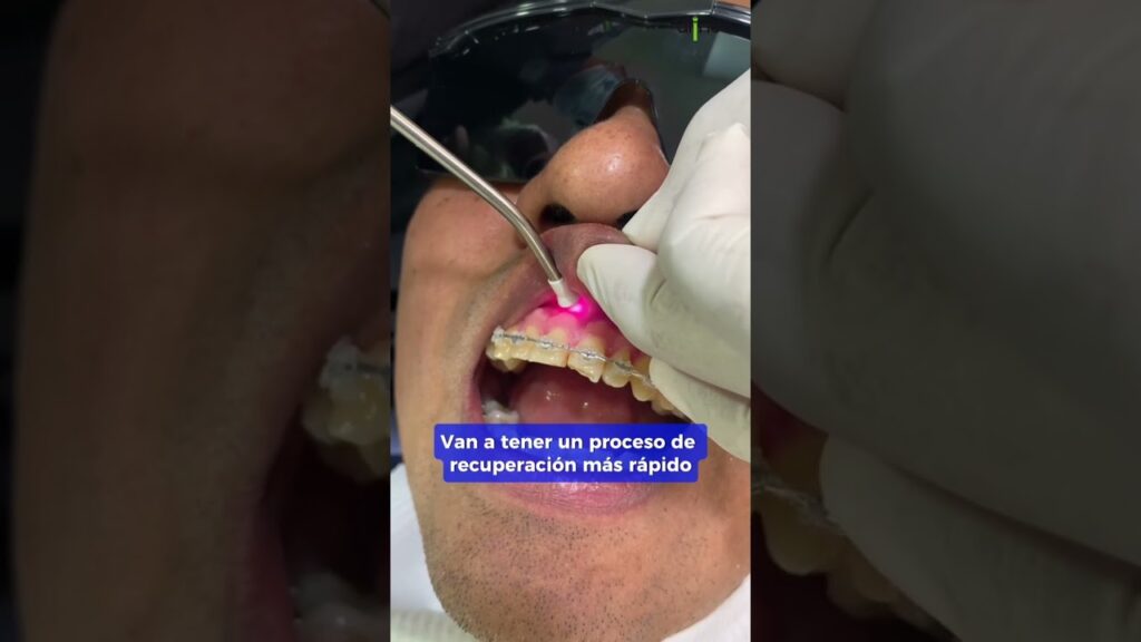 laser ortodoncia dentifrico