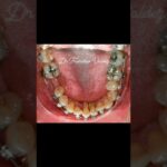 latiguillo prezion bucal ortodoncia periodoncia