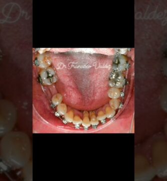 latiguillo prezion bucal ortodoncia periodoncia