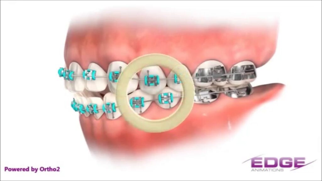 ligas interproximales ortodoncia