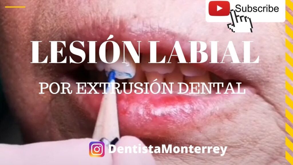 limitaciones de la ortodoncia extrusion