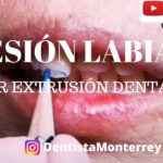 limitaciones de la ortodoncia extrusion