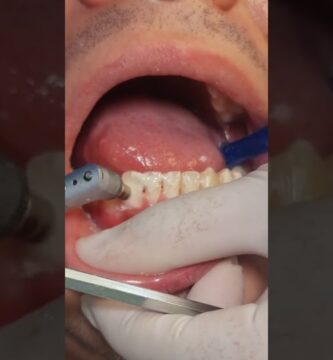 limpieza dental despues de ortodoncia