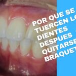 los dientes se tuercen despues de la ortodoncia