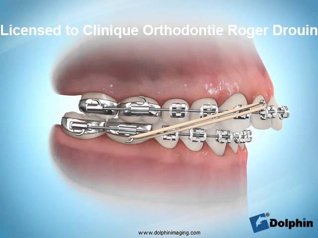 maloclusion clase 2 ortodoncia