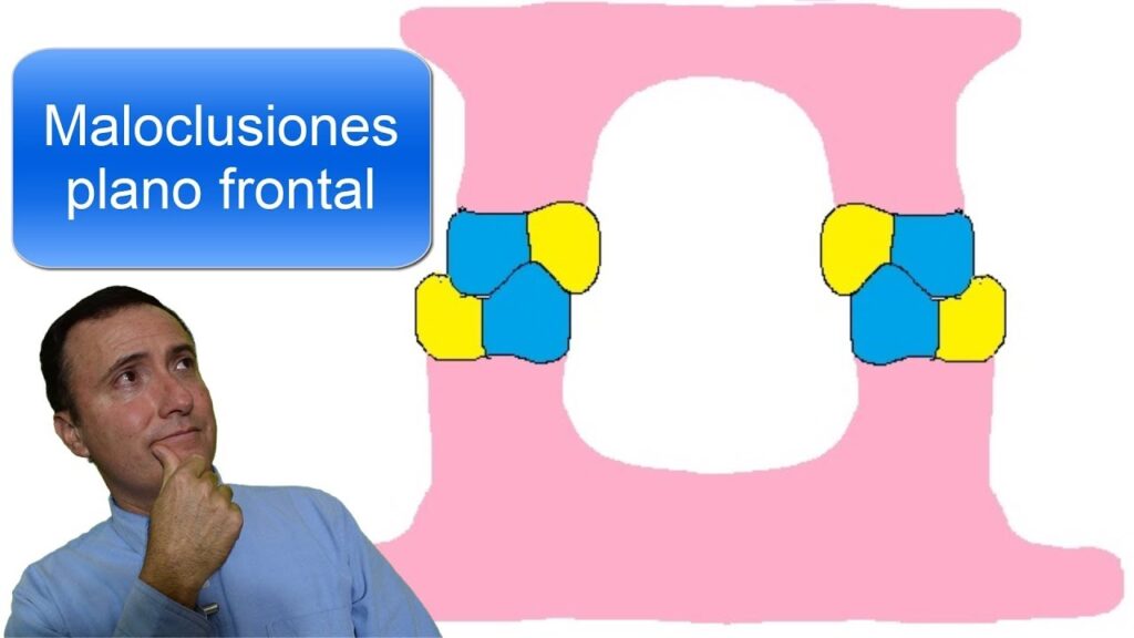 maloclusiones plano frontal ortodoncia