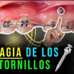 material microtornillos ortodoncia