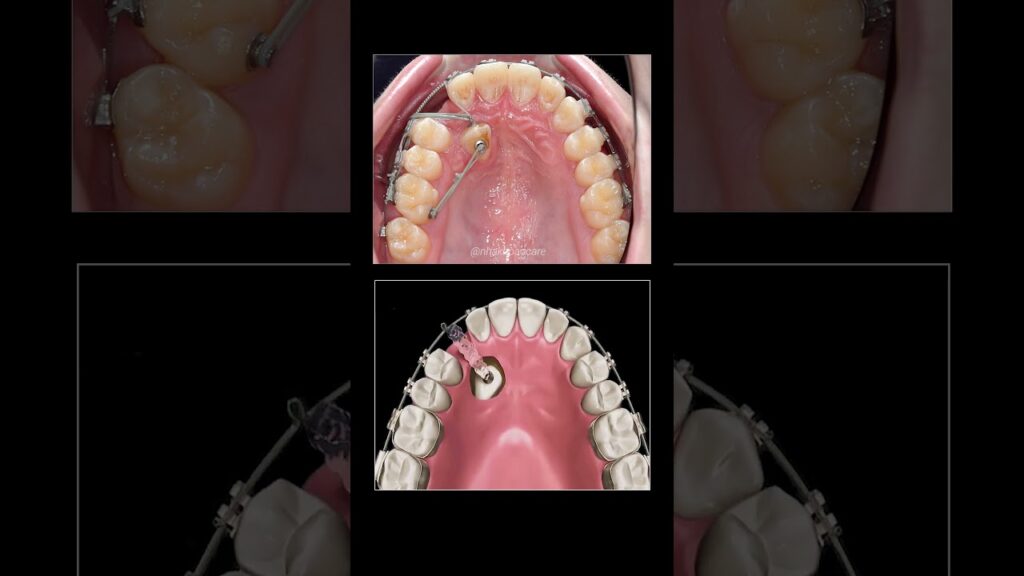 mecanic tooth interaction in ortodoncia