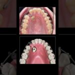 mecanic tooth interaction in ortodoncia