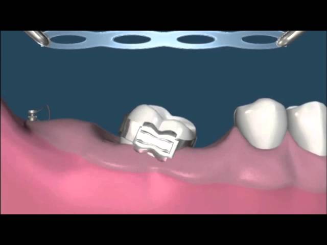 mesial en ortodoncia