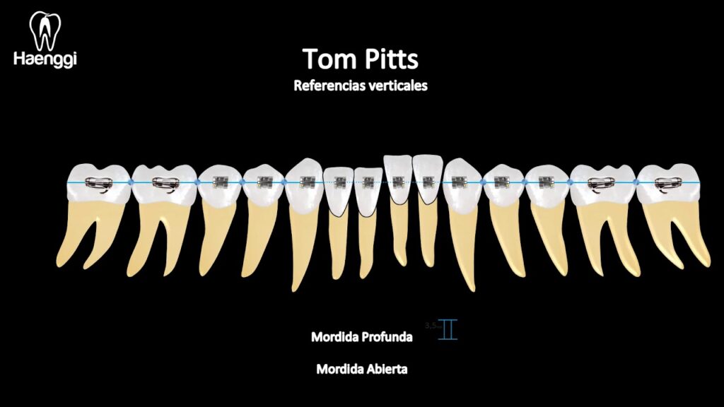 metodo sap ortodoncia