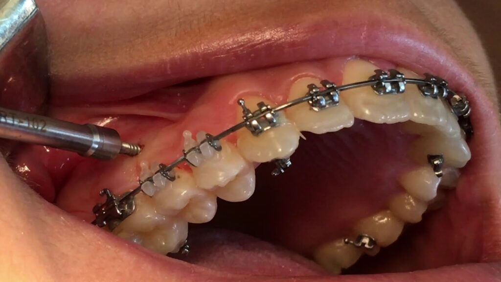 microimplantes y elasticos ortodoncia