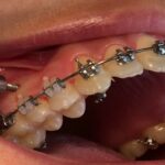 microimplantes y elasticos ortodoncia