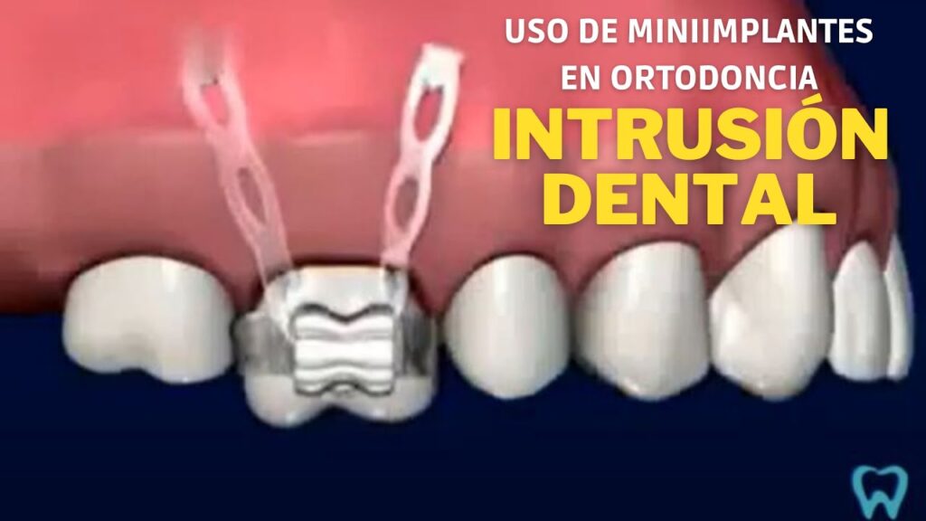 microtornillos ortodoncia en encia para intrusion de molares