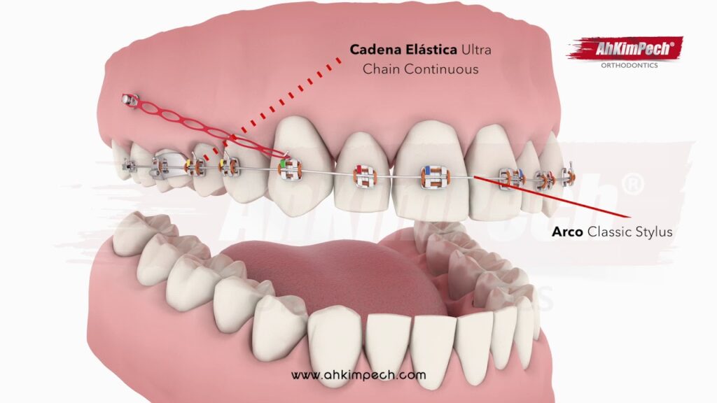 microtornillos ortodoncia maloclusion 2