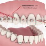 microtornillos ortodoncia maloclusion 2