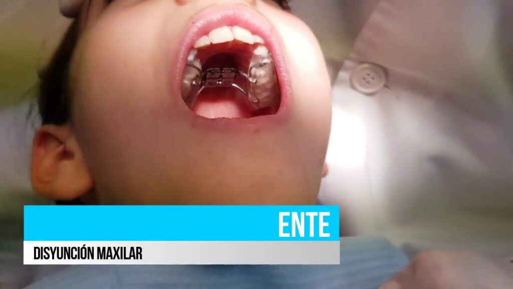 molestias con expansor ortodoncia