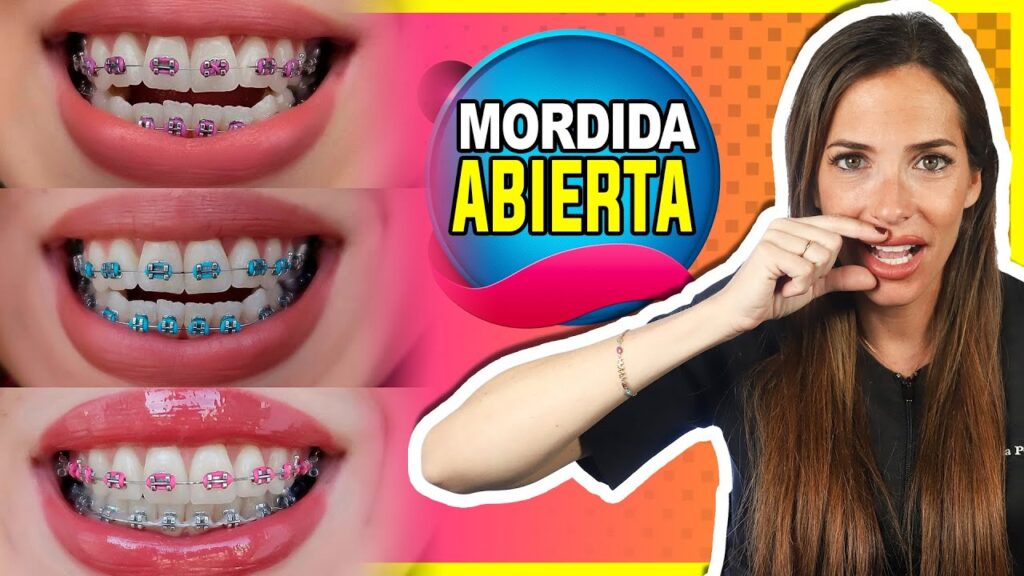 mordida abierta despues ortodoncia perfil