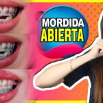 mordida abierta despues ortodoncia perfil