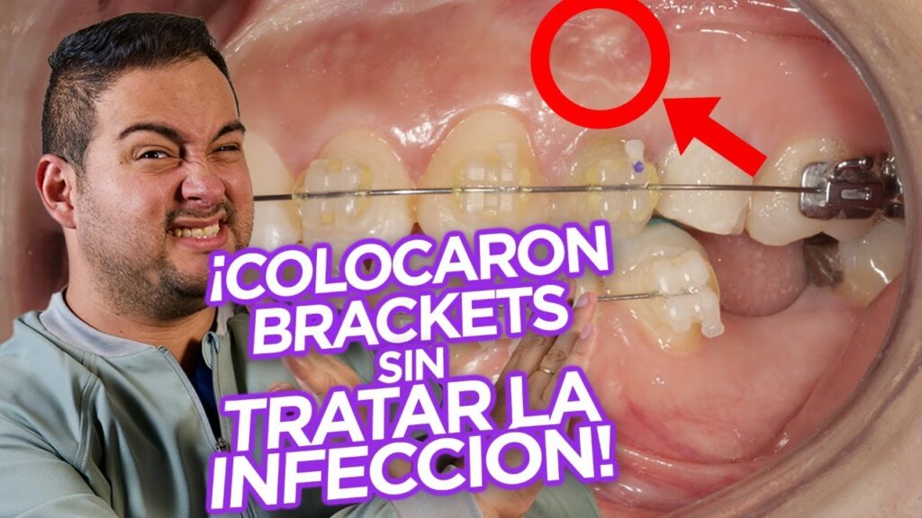 mover dientes endodonciados con ortodoncia