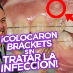 mover dientes endodonciados con ortodoncia